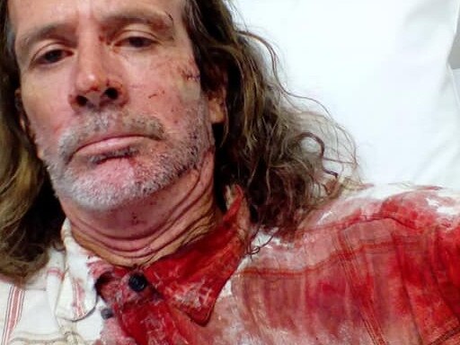 Dominic Ryan, 54 from Carrara, was assaulted at Nerang RSL on Friday October 9. He was given eight stitches at Robina Hospital. Photo: Supplied.