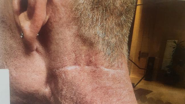 The scar Mr Whitehead was left with after the alleged attack by Mr Robinson. Photo: Courts SA