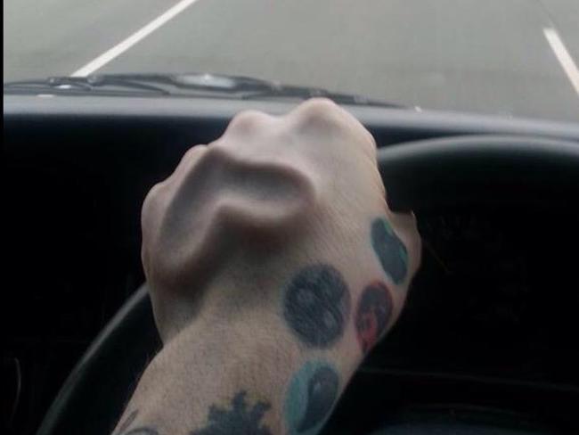 A Facebook image of a hand implant Brendan Russell claimed he had performed.