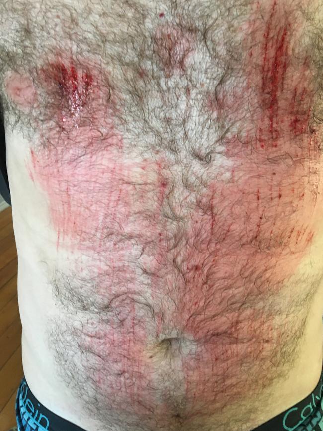 Scratches on Luke Ferguson’s torso