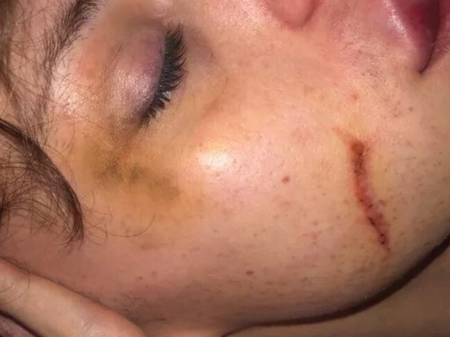 Transgender woman Chyna was left bloodied and bruised by mystery attackers in Docklands early on Sunday February 19. Picture: Supplied