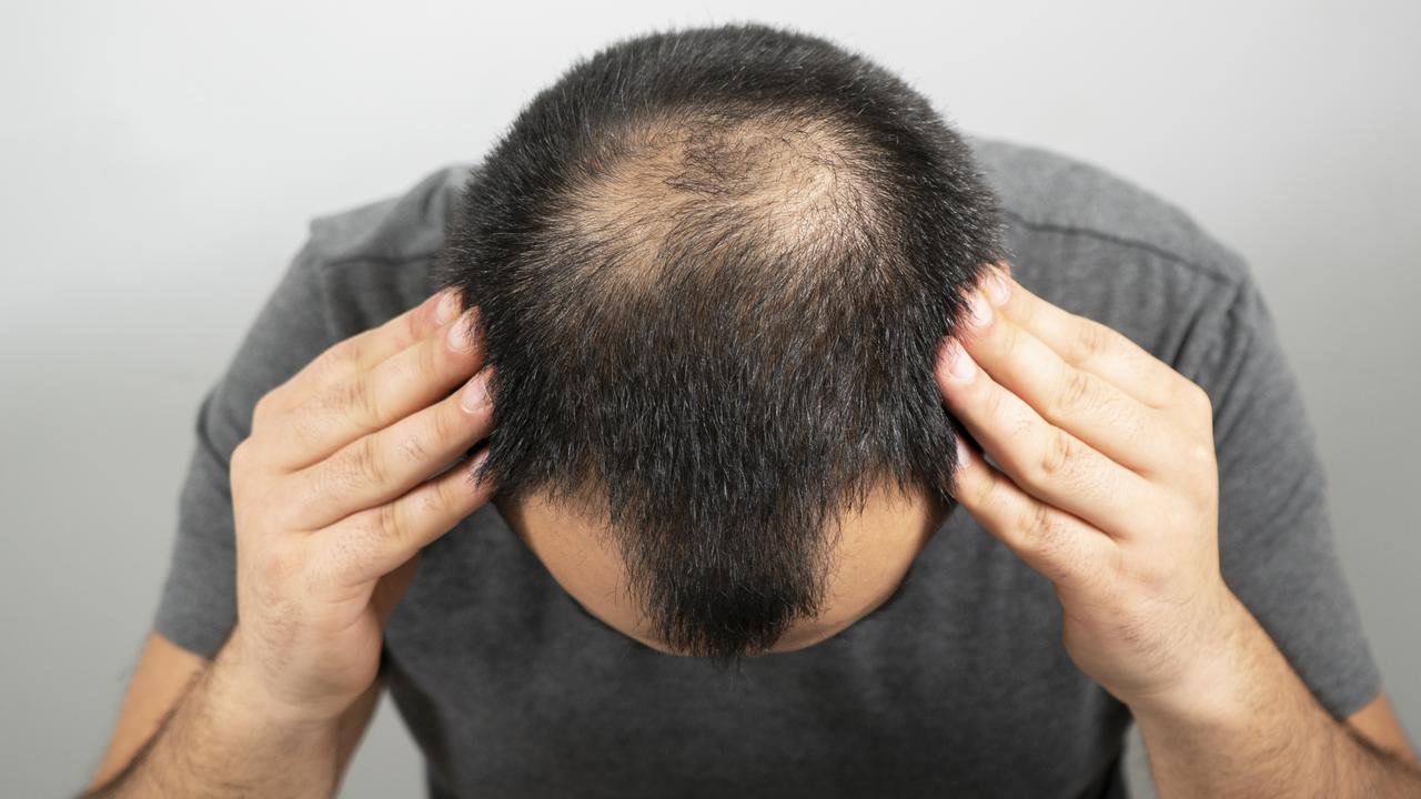 Male hair loss is affecting more young men than you might think. Picture: iStock.