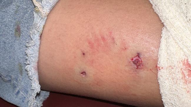 A mum is frustrated a dog was not seized by the council after her daughter was attacked in Wulagi. Picture: Supplied.