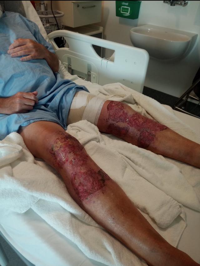 Mr Orr’s legs after graft surgery for severe burns. Picture Gregory Orr