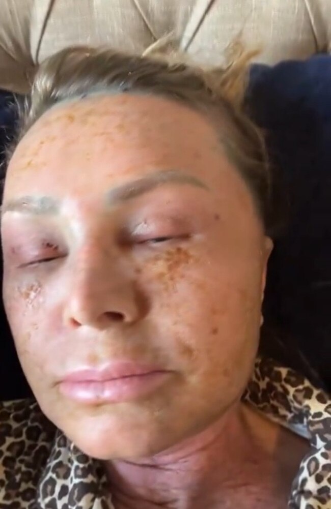 After three days in recovery, Judge's face appeared to be getting more swollen and the star told fans she was still "oozing". Picture: TikTok.