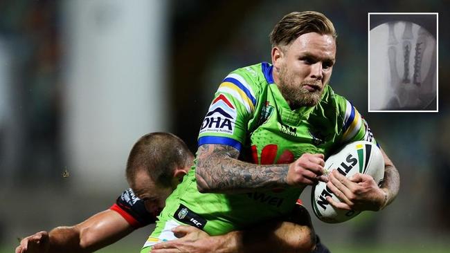Blake Austin will look to return despite recent hand surgery.