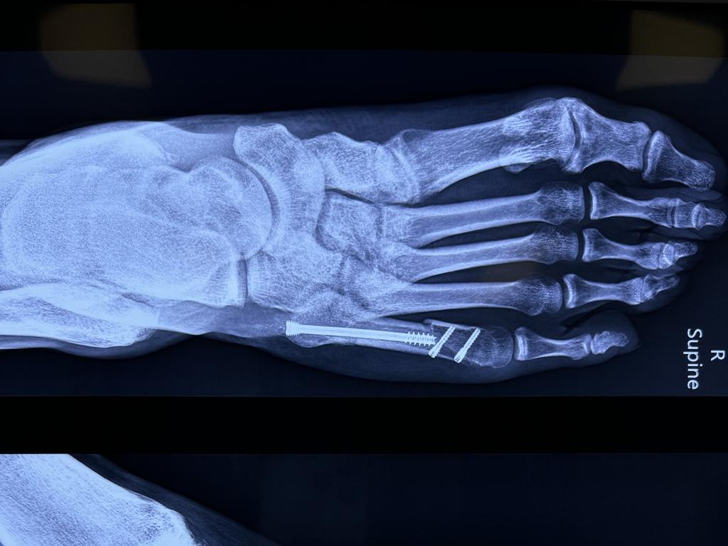 X-rays of Tevita Tatola's second foot surgery. Picture: Supplied.