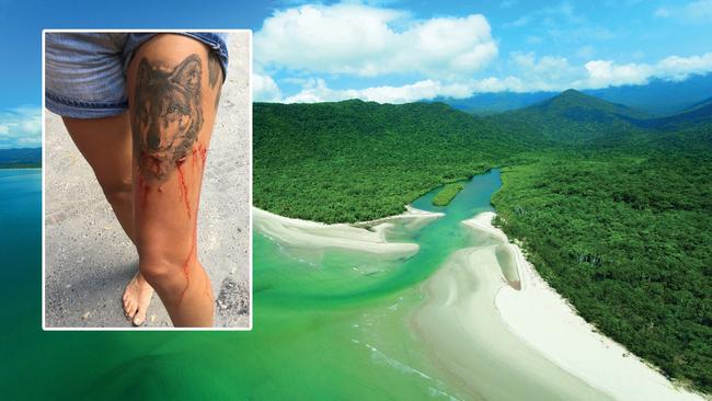 A 24-year-old British tourist shows off the crocodile bite she sustained while walking through shallow waters at Cape Tribulation. Source: Facebook