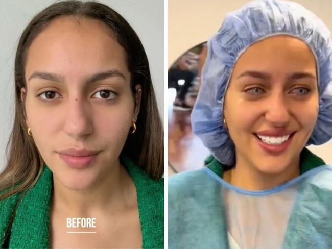 Experts have warned against an iris colour-changing procedure going viral on social media, saying it can result in blindness. Picture: TikTok