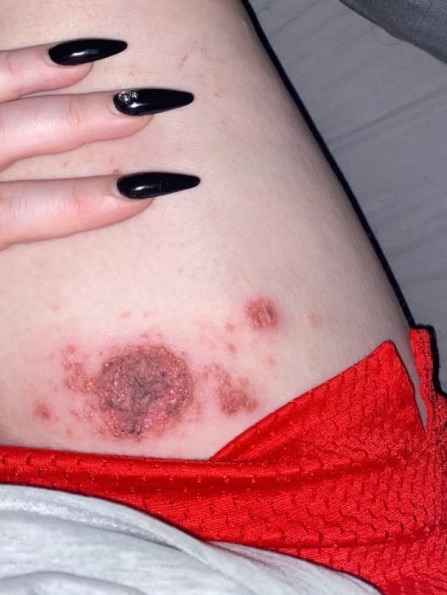 Eczema is debilitating for thousands of Aussies like Leilah. Picture: Supplied