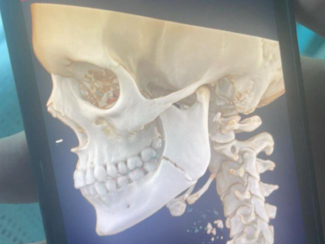 Poppy’s X-rays, which show her fractured left jaw. Picture: Supplied