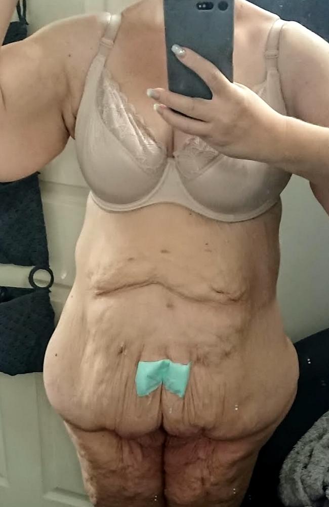 Woman rejected on Tinder after losing 114kg and sending photos of excess  skin