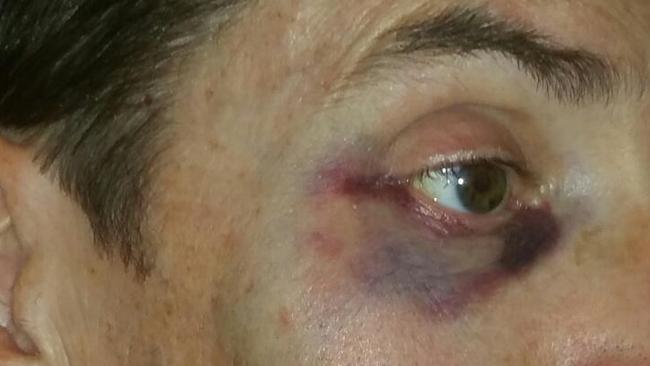 Cyclist Paul was bashed by another rider in a vicious road rage attack in Seaford.