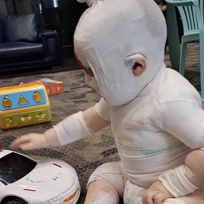 The mother of a baby Luka,, burned by coffee in a shocking random attack in a Brisbane park has shared an incredible update as her son faces his third surgery. Picture: Supplied ,