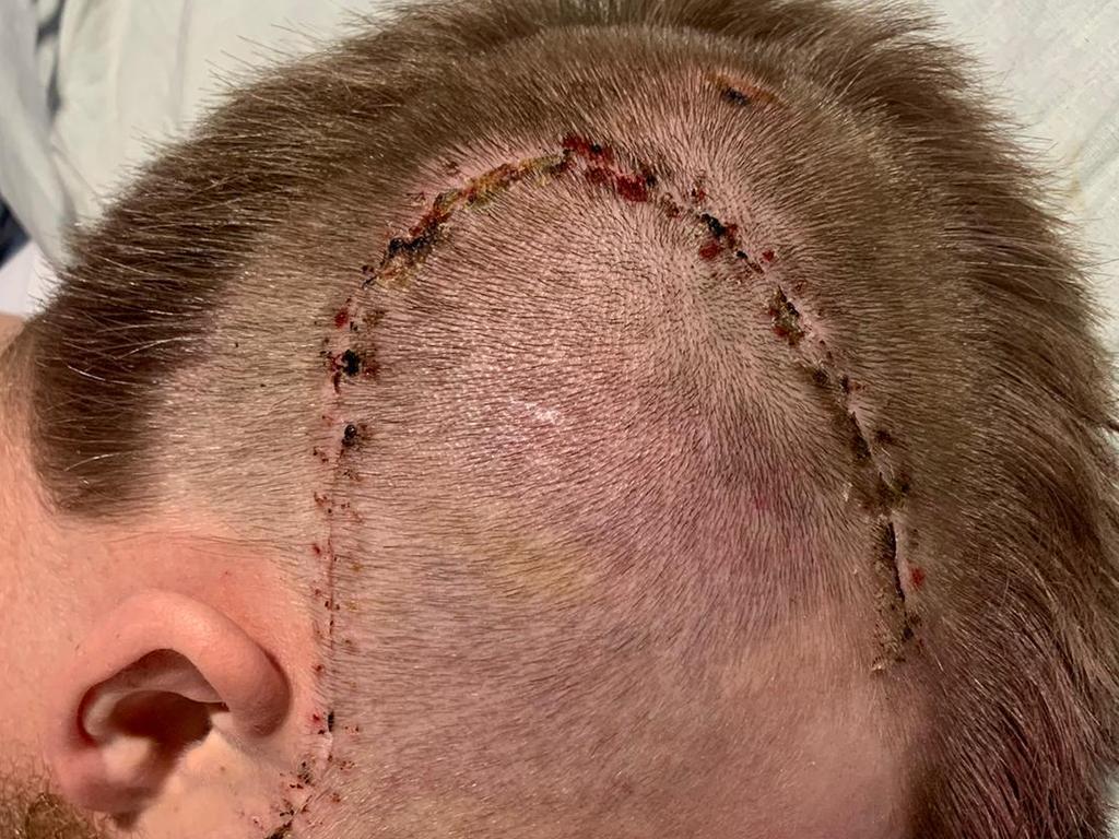 Harry Frolling bears the scars of surgery to repair his fractured skull and alleviate bleeding on the brain. Picture: Shane Froling/Twitter