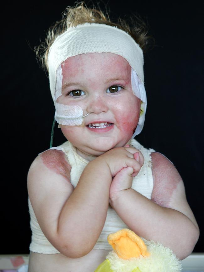 Matilda Philp, 2, in 2008 after suffering burns when she tried to reach for a toy and fell into a scalding bath. Picture: Rebecca Michael