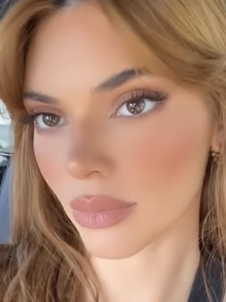 Kendall took to Instagram showing off her "exploded" lips.