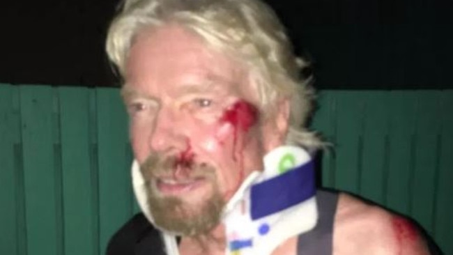 X-rays reveal Richard Branson had suffered a cracked cheek and some torn ligaments. Picture: Virgin.