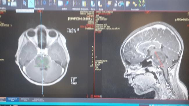 Bella Howard’s brain scans ahead of her operation. Picture: Supplied