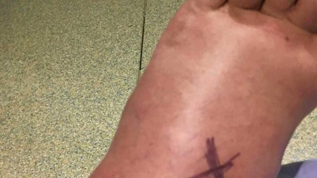 Snake bite victim Mr Peter Maddocks left ankle after being bitten by an Eastern Brown snake three weeks ago, west of Gympie. Picture: CONTRIBUTED