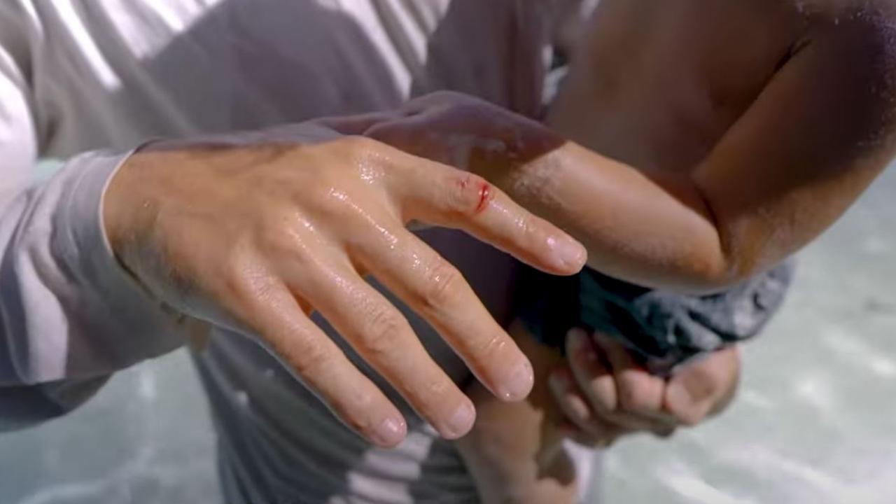 He had to have multiple injections in his finger. Picture: YouTube/Sailing La Vagabonde