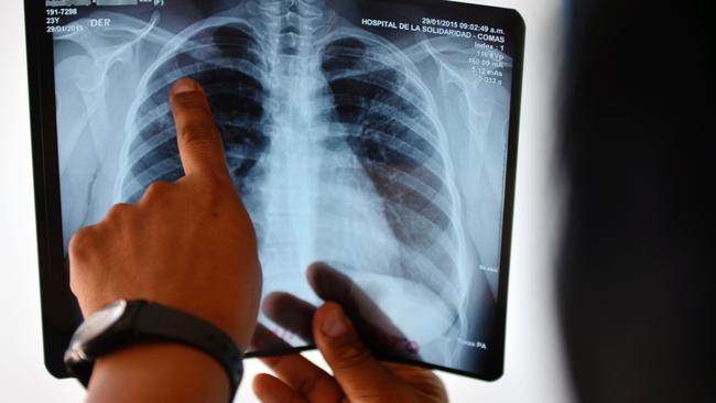 Patient with tuberculosis ‘wrongly diagnosed’ by Sydney doctor talks ...