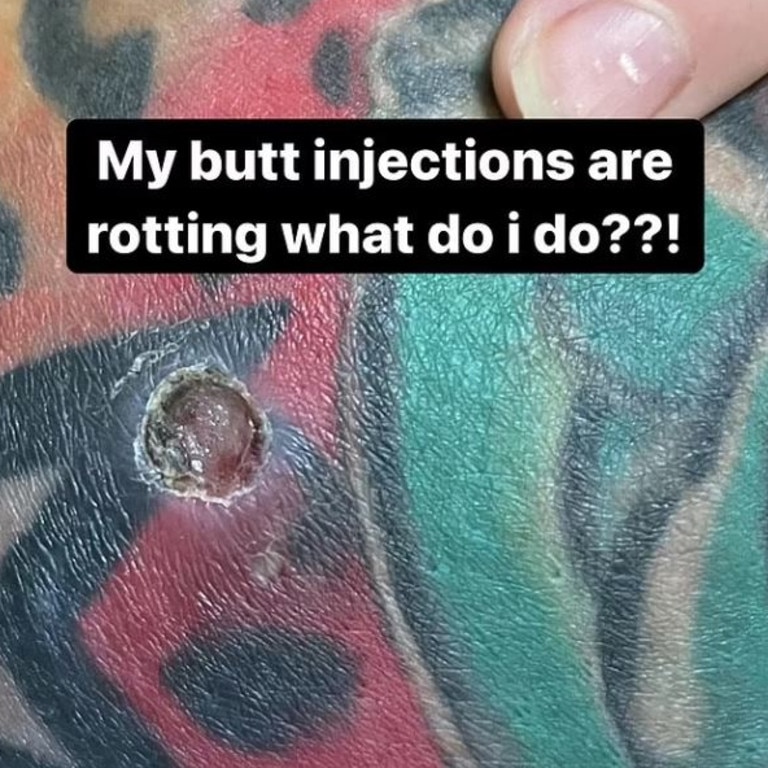 Mary recently shared photos of an open wound after her body rejected illegal silicone injections she had in her buttocks. Picture: Instagram/1800leavemaryalone