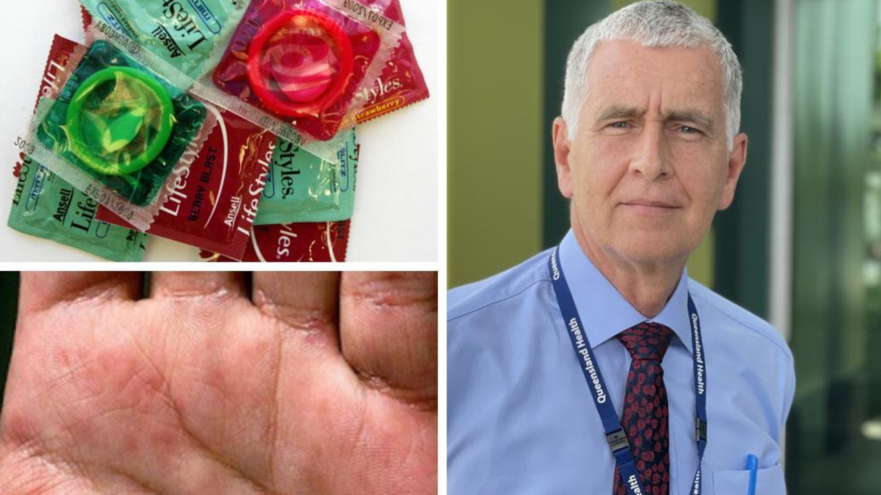 Mackay a syphilis hotspot as docs urge condoms testing on