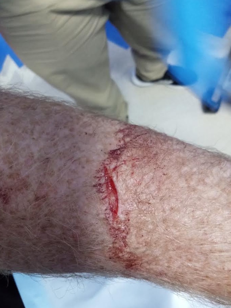 The stab wound of a state care worker attacked by a 14-year-old girl. Picture: Supplied