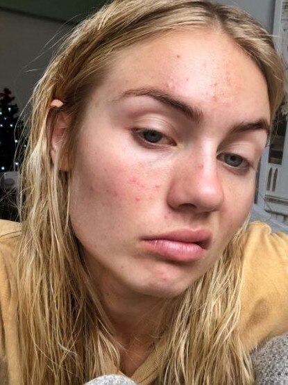 She went through two rounds of Roaccutane, but it still didn’t help.