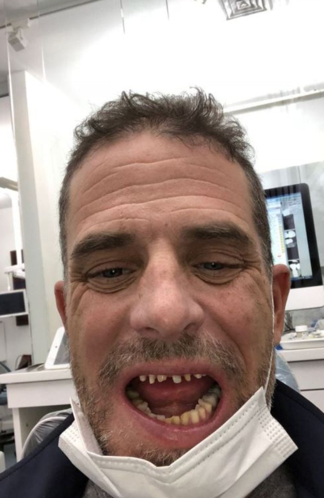 Hunter Biden’s filed down teeth readied for work as he sits in a dental chair after years as a crack addict.