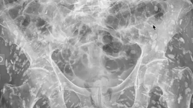 The X-ray revealed the man had hundreds of tapeworm eggs inside him. Picture: X