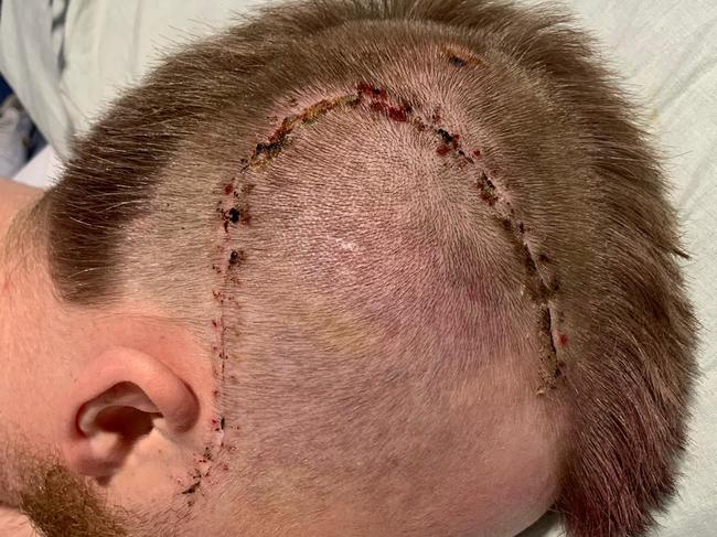 Harry Froling bears the scars of surgery to repair his fractured skull and alleviate bleeding on the brain. Picture: Shane Froling/Twitter