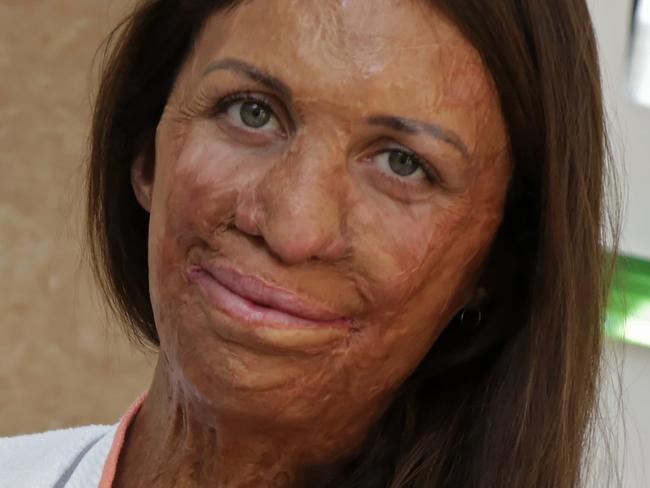 Turia Pitt opens up on the tiny town helping to treat her skin.