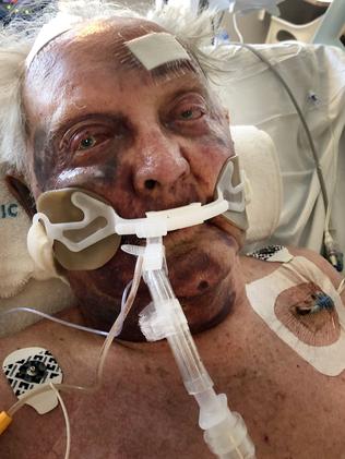 A battered and bruised Piet Els after being attacked on his farm.