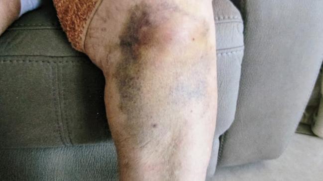 Suzanne Gransden’s leg days after her second wallaby attack at Carlyle Gardens.