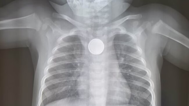 An x-ray showed a button battery lodged in the one-year-old's throat. Source: supplied