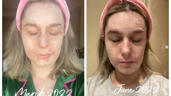 Stephanie Browitt survived the disaster and has spent the last 2.5 years undergoing dozens of excruciating surgeries and skin grafts. Picture: Instagram.
