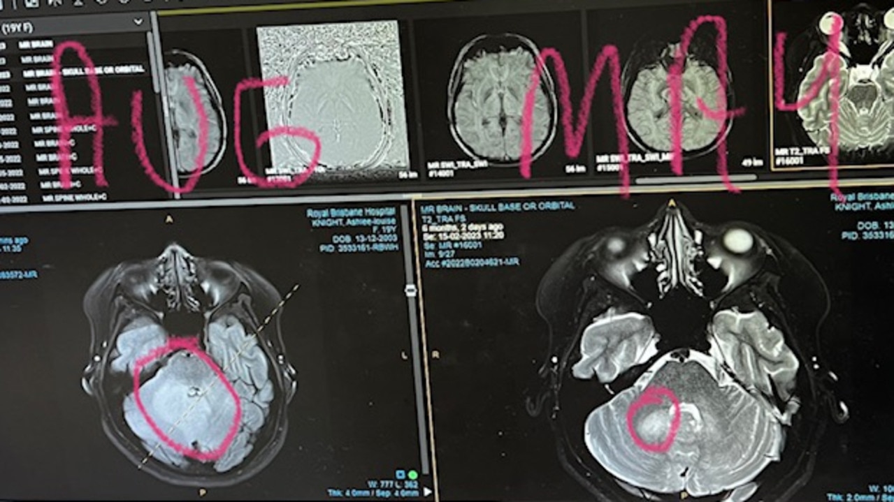 Ashlee Knight's brain scan in 2023 when her mum said they were 