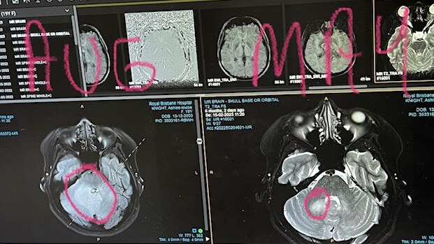 Ashlee Knight's brain scan in 2023 when her mum said they were 