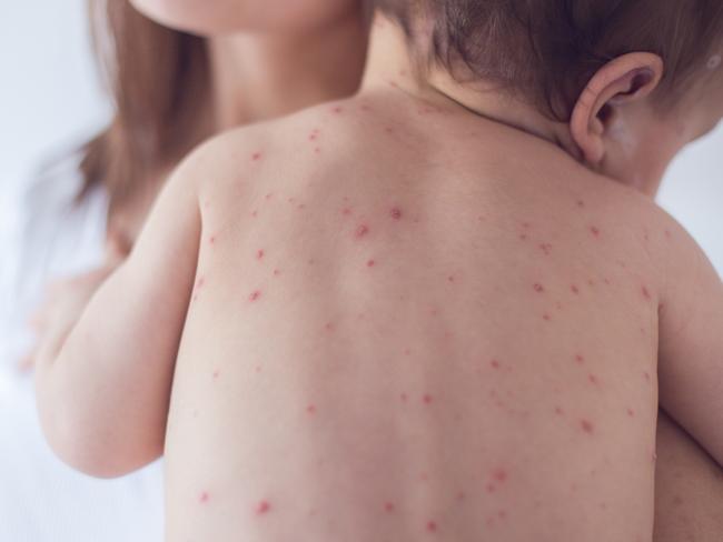 Children as young as six months can be safely given the measles vaccine if they are heading overseas.