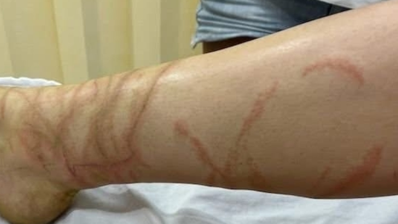 ‘I’m literally dying’: Girl lucky to be alive after jellyfish sting