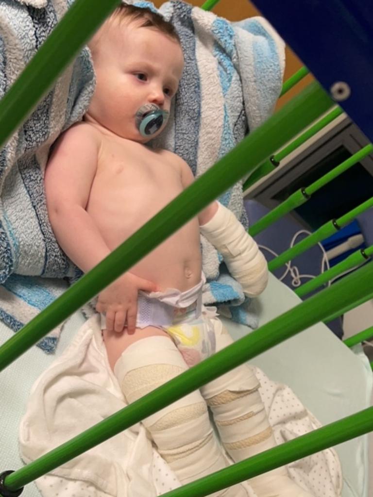 Blake Nilssen suffered burns at nursery in the UK. Picture: Digby Brown Solicitors/SWNS/Mega.