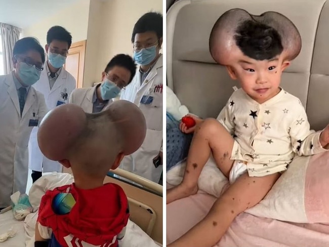 A three-year-old boy who was cruelly dubbed ‘Mickey Mouse’ over swelling caused by treatment for a rare skin condition has undergone an amazing transformation.