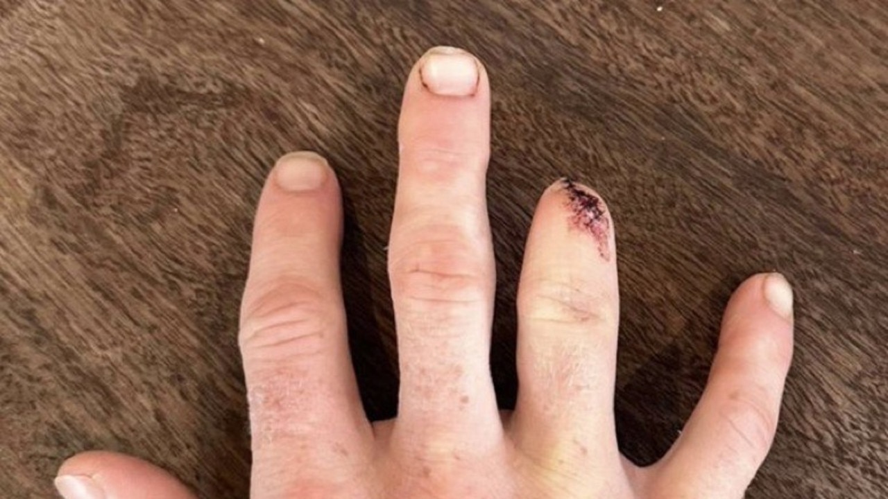 WARNING GRAPHIC IMAGE Hockeyroo Matt Dawson’s gruesome finger photos after being hit by a hockey stick in a practice match only weeks out from Paris