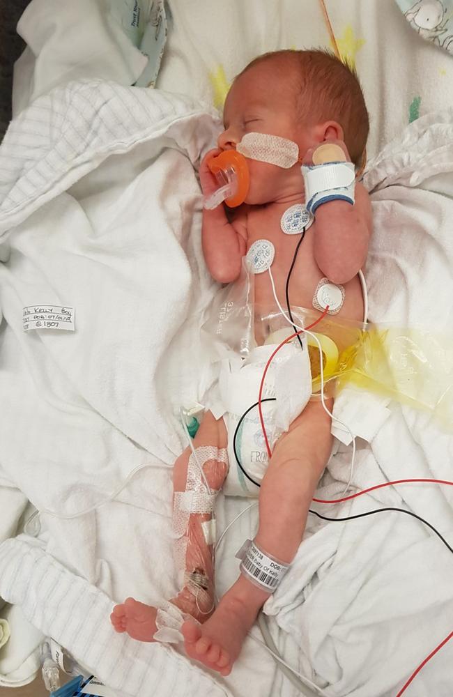 Oliver Glover was born with Short Gut syndrome and spent some time in hospital. Picture: Kelly Glover