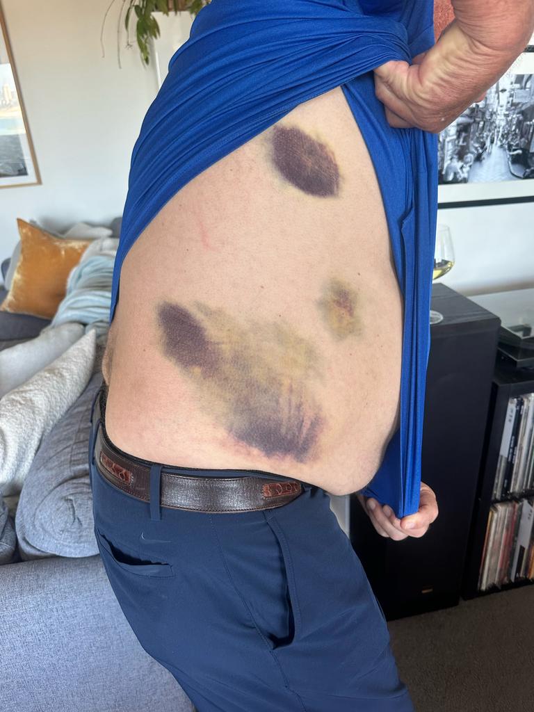 Botham's bruised body after falling into the river.