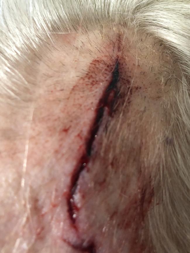 A wound to Mrs Tilley’s head after a fall at Bupa Baulkham Hills.