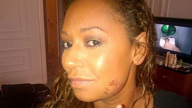 Mel B explained this injury on her face on Twitter as a result of “Running in 7 inch louboutin no good! I'm wearing Prague on my face!!! Picture: OfficialMelB/Twitter