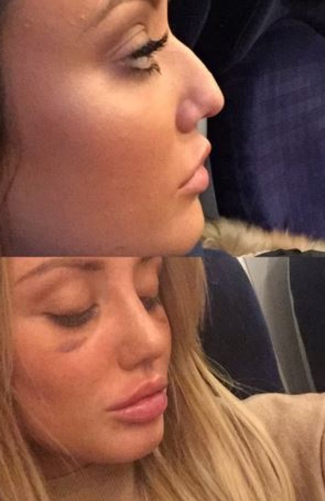 Charlotte Crosby showed off her new nose on Twitter